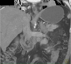 Renal Lymphoma - CTisus CT Scan