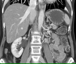 Collaterals Near Left Kidney in Patient With Infiltrating Pancreatic Cancer - CTisus CT Scan