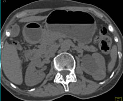 High Density Renal Cyst - CTisus CT Scan