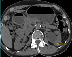 High Density Renal Cyst - CTisus CT Scan