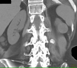 High Density Renal Cyst - CTisus CT Scan