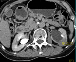 High Density Renal Cyst - CTisus CT Scan