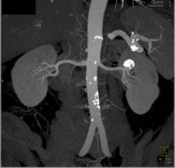 Renal Artery Aneurysm - CTisus CT Scan