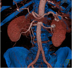 Renal Artery Aneurysm - CTisus CT Scan