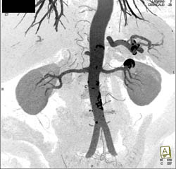 Renal Artery Aneurysm - CTisus CT Scan