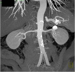 Renal Artery Aneurysm - CTisus CT Scan