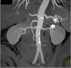 Renal Artery Aneurysm - CTisus CT Scan