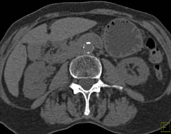 Subtle Transitional Cell Cancer (TCC) Right Kidney- See Sequence of Images - CTisus CT Scan