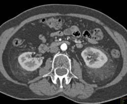 Perinephric Stranding Around the Right and Left Perirenal and Pararenal Space - CTisus CT Scan