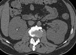 Erdheim-chester Disease Infiltrates the Perirenal Space- Amazing Case. See Full Sequence of Images - CTisus CT Scan