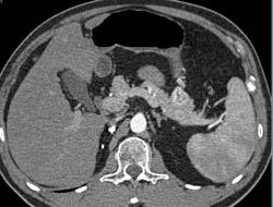 Right Nephrectomy With Metastases to Pancreas Best Seen on 3D Images - CTisus CT Scan