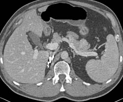 Recurrent Renal Cell Carcinoma With Pancreatic Metastases - CTisus CT Scan