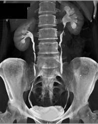 CT Urogram With Mild Left Caliectasis - CTisus CT Scan