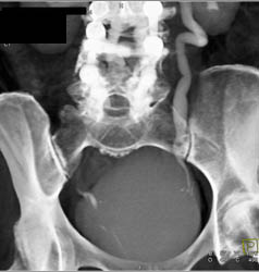 Dilated Ureter - CTisus CT Scan