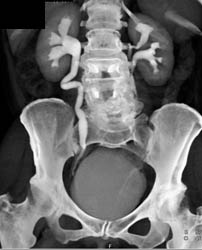 Ct Urogram With Editing Volume of Dataset. Note Duplicated Left Collecting System - CTisus CT Scan