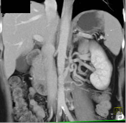 Dilated Vessels in the Left Renal Pelvis With Collaterals - CTisus CT Scan