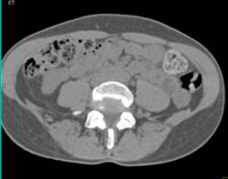 1 Cm Renal Cell Caricnoma in Right Kidney at Various Phases - CTisus CT Scan