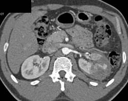 Renal Laceration and Decreased Perfusion S/P GSW - CTisus CT Scan