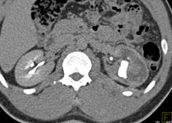 Ct Urogram With Decreased Function of Left Kidney - CTisus CT Scan