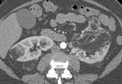 Bilateral Renal Angiomyolipomas (AMLs) - CTisus CT Scan