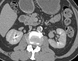 Renal Artery Aneurysm Simulates A Mass in Left Renal Hilum - CTisus CT Scan
