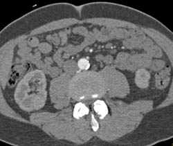 High Density Renal Cyst in Lower Pole of the Right Kidney - CTisus CT Scan