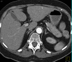 Atherosclerotic Disease in Celiac and SMA - CTisus CT Scan