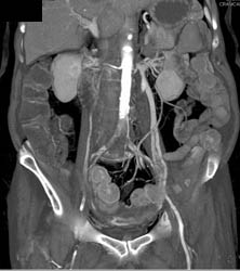 Pelvic Congestion Syndrome With Dilated Pelvic Veins and Gonadal Veins - CTisus CT Scan