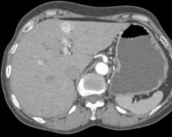 Renal Cell Carcinoma With Liver and Pancreatic Mestases - CTisus CT Scan