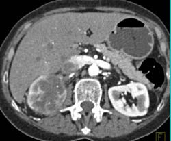 Renal Cell Carcinoma With Renal Vein and IVC Involvement - CTisus CT Scan