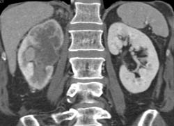 Delayed Enhancement Right Kidney Due to Transitional Cell Cancer (TCC) - CTisus CT Scan