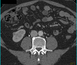 1 Cm Renal Cell Cancer - CTisus CT Scan