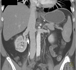 1 Cm Renal Cell Carcinoma - CTisus CT Scan