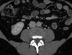 1 Cm Renal Cell Carcinoma - CTisus CT Scan