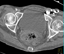 Chyle Collection Behind Left Kidney Due to Lymphatic Leak. See Contrast From Lymphangiogram - CTisus CT Scan