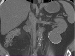 Cystic Renal Cell Carcinoma - CTisus CT Scan