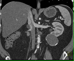 Cystic Renal Cell Carcinoma - CTisus CT Scan