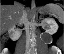 Cystic Renal Cell Carcinoma - CTisus CT Scan