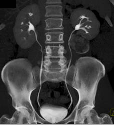 Cystic Renal Cell Carcinoma - CTisus CT Scan