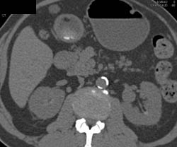 Renal Artery Aneurysm Simulates A Mass - CTisus CT Scan