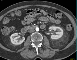 Peri-renal Stranding in Autoimmune Pancreatitis - CTisus CT Scan