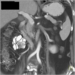 Pseudo-clot in Left Gonadal Vein - CTisus CT Scan