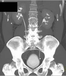 Normal CT Urogram - CTisus CT Scan