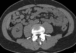 Renal Cell Carcinoma Not Well Seen in Non Constant Exam But Then Seen on Later Phases - CTisus CT Scan