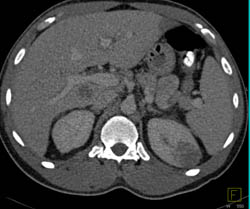 Renal Cell Carcinoma - CTisus CT Scan