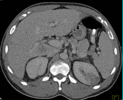 Renal Cell Carcinoma - CTisus CT Scan