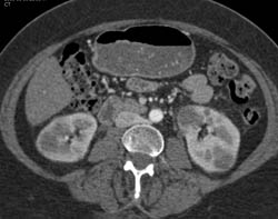 Metastatic Disease to the Kidneys From A Pancreatic Primary - CTisus CT Scan