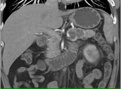 Renal Cell Carcinoma and Cystic Pancreatic Lesion - CTisus CT Scan