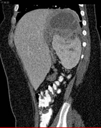 Renal Abscess - CTisus CT Scan