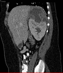 Renal Abscess - CTisus CT Scan